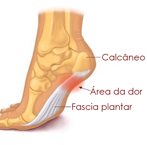 Dores na planta do pé - Metatarsalgia. Saiba como resolver este problelma
