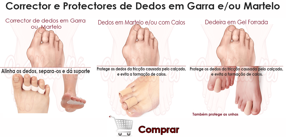 Dedos Sobrepostos Dedos Em Garra E Martelo Saiba Tudo Aqui 